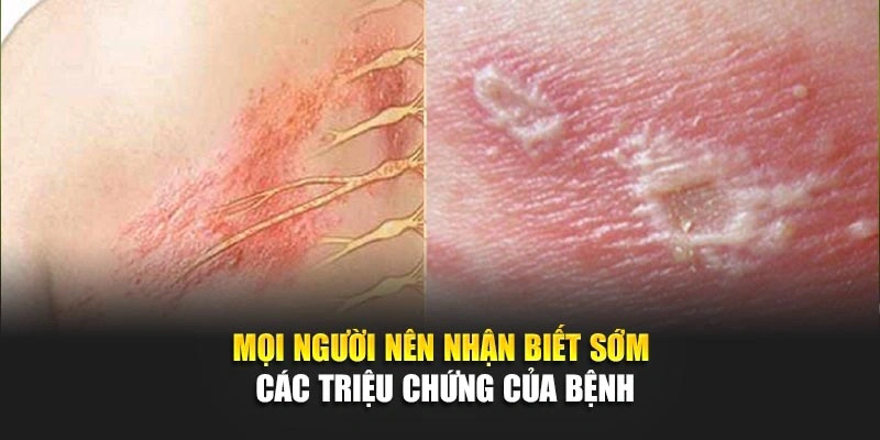 Mọi người n&ecirc;n nhận biết sớm c&aacute;c triệu chứng của bệnh