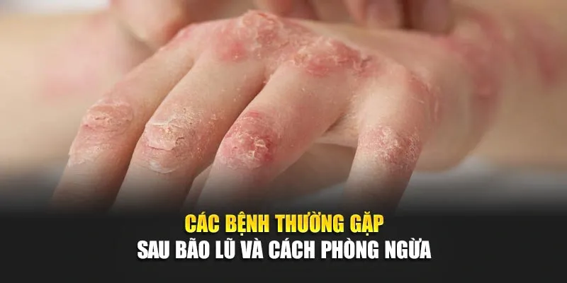 Các Bệnh Thường Gặp Sau Bão Lũ Và Cách Phòng Ngừa